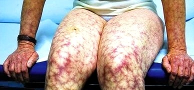 antifosfolipid syndrom antifosfolipid syndrom